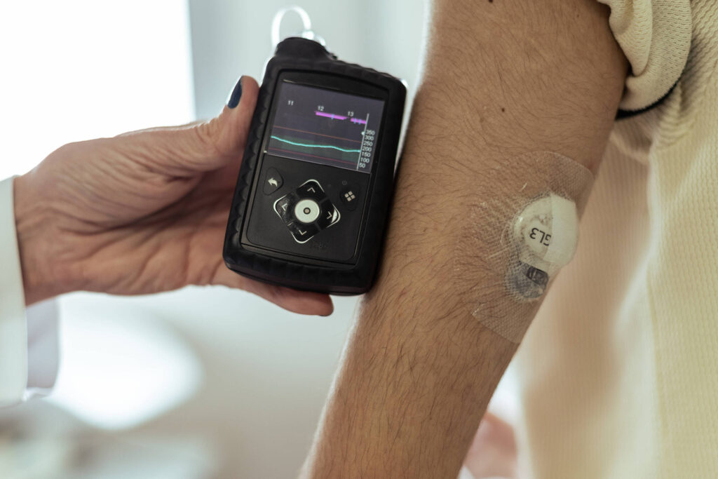 Pâncreas artificial controla diabetes e reduz picadas - 19/06/2025 - Equilíbrio e Saúde