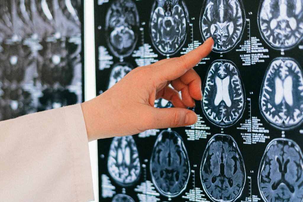Modelo 3D acompanha metástase cerebral em tempo real - 26/08/2025 - Equilíbrio e Saúde