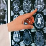 Modelo 3D acompanha metástase cerebral em tempo real - 26/08/2025 - Equilíbrio e Saúde