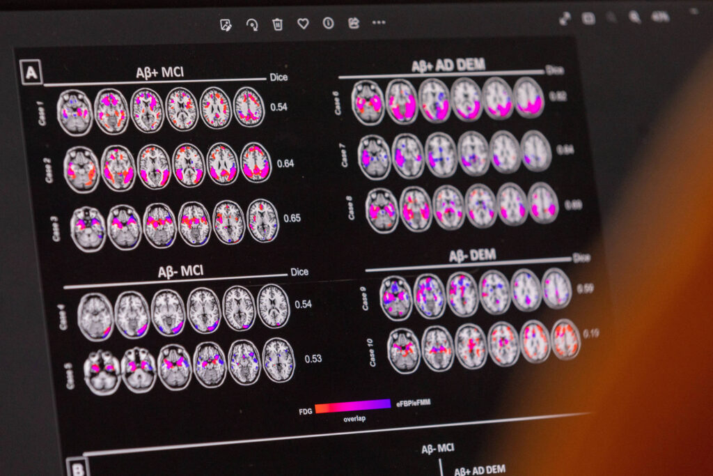 Novo medicamento para Alzheimer inicial chega ao Brasil - 01/09/2025 - Equilíbrio e Saúde