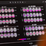 Novo medicamento para Alzheimer inicial chega ao Brasil - 01/09/2025 - Equilíbrio e Saúde