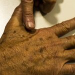 Desinformação sobre câncer de pele afeta diagnóstico, diz instituição